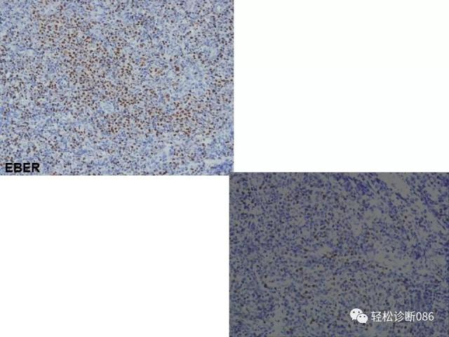 HIV/AIDS相关性LPDHIV感染相关淋巴瘤病例分析
