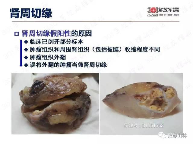 泌尿系统常见肿瘤标本病理报告规范