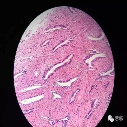 子宫腺肉瘤【吴梅娟】分享；【刘从容】老师讲解）