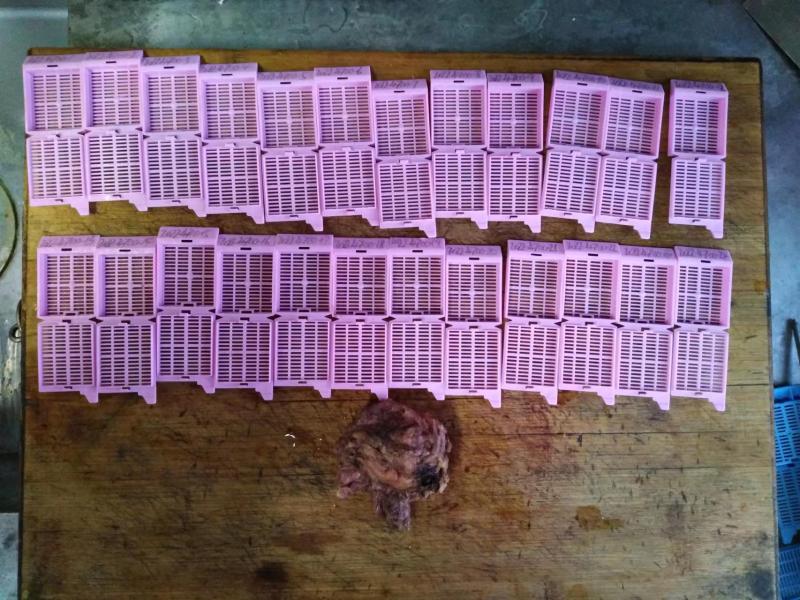 前列腺癌诊断的听课笔记（八十五）