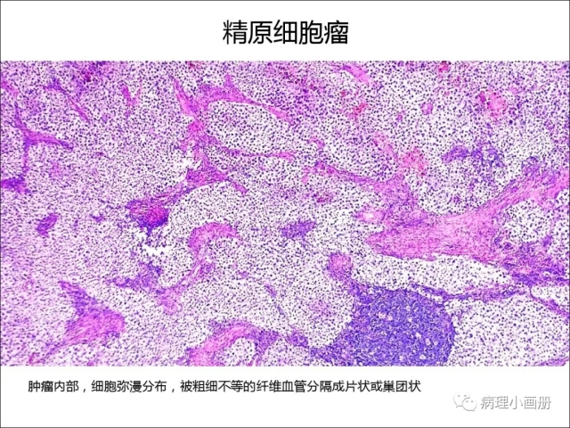 泌尿病理--精原细胞瘤VS精母细胞瘤