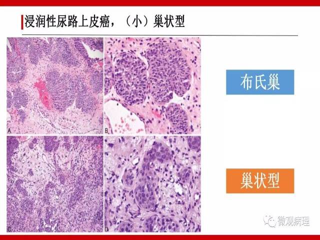 泌尿课程/浸润性尿路上皮癌病理学类型