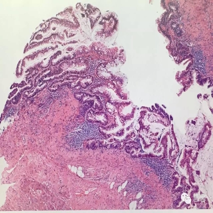 低级别黏液性肿瘤转移到卵巢伴腹腔假黏液瘤形成【小车】分享；【刘从容】老师讲解