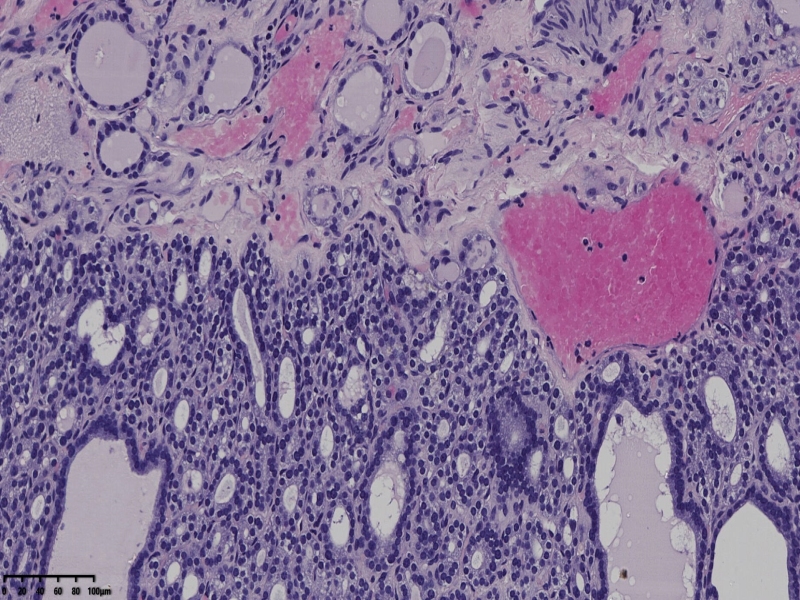 这个甲状腺肿瘤怎么看？