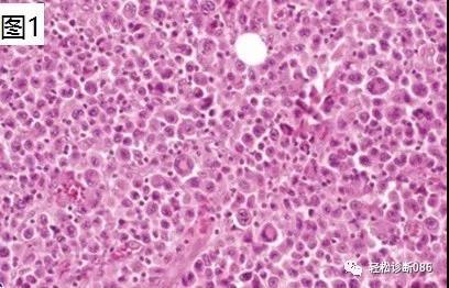 皮肤淋巴瘤(8)——T-NHL（CD30+LPD）