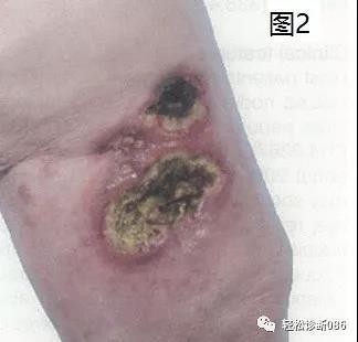 皮肤淋巴瘤(8)——T-NHL（CD30+LPD）