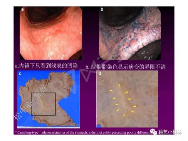 上消化道早癌病理的学习心得体会（附胃牵手癌的病例特点文献学习）