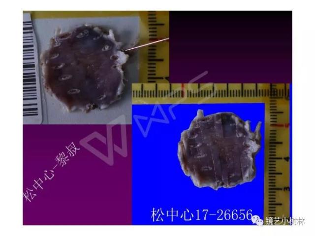 上消化道早癌病理的学习心得体会（附胃牵手癌的病例特点文献学习）