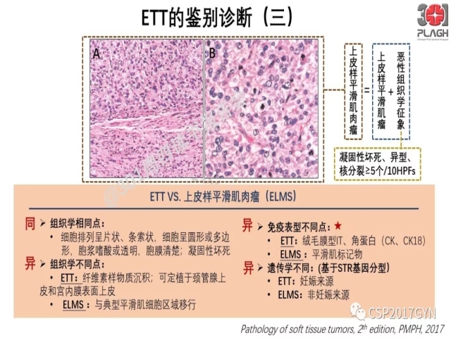 中间型滋养细胞肿瘤的诊断及鉴别诊断