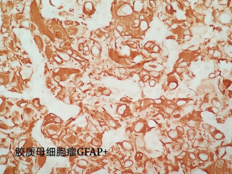 病理科工作札记（三十八）胶质母细胞瘤