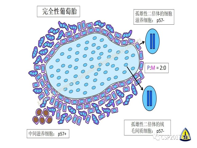 p57免疫组化染色及基因分型 在葡萄胎精确诊断中的应用