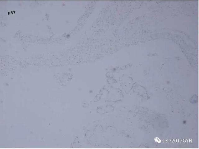 妊娠滋养细胞肿瘤的临床病理学进展