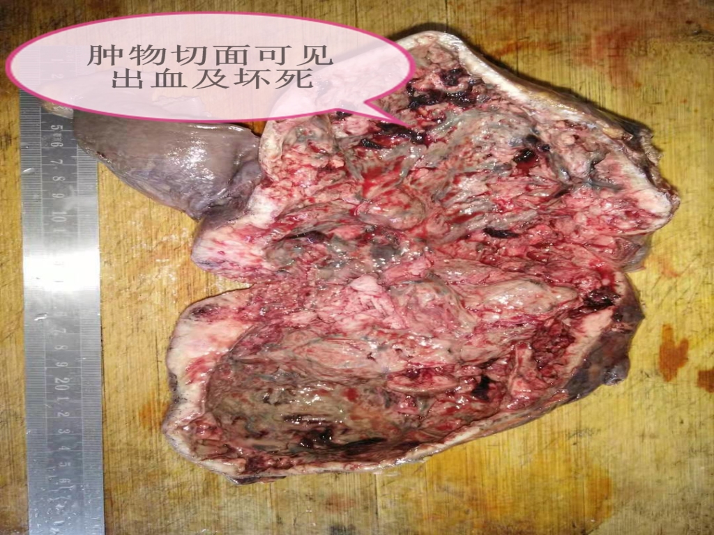 外伤引发间质瘤出血——病理科工作札记（五十五）
