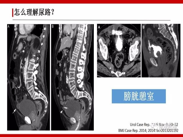 泌尿课程/尿路腺样病变的诊断要点