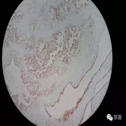 透明细胞乳头状肾细胞癌？TFE3 Traslocation Carcinoma？（赵洋分享，孔祥田(Max)*NM老师讲解）