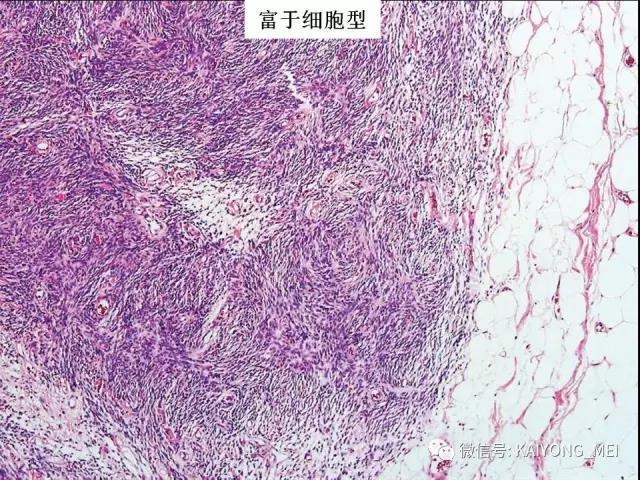 乳腺梭形细胞病变的病理诊断及进展（一）
