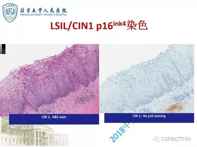 宫颈鳞状上皮内病变病理诊断中问题