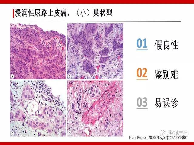 泌尿课程/浸润性尿路上皮癌病理学类型
