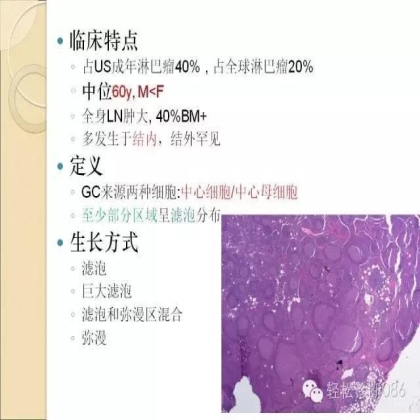 滤泡性淋巴瘤