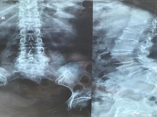 医生及患者通用:如何用手机翻拍X线片,磁共振片子,CT片子进行网络求医、病例讨论及保留资料 医生及患者通用:如何用手机翻拍X线片,磁共振片子,CT片子进行网络求医、病例讨论及保留资料