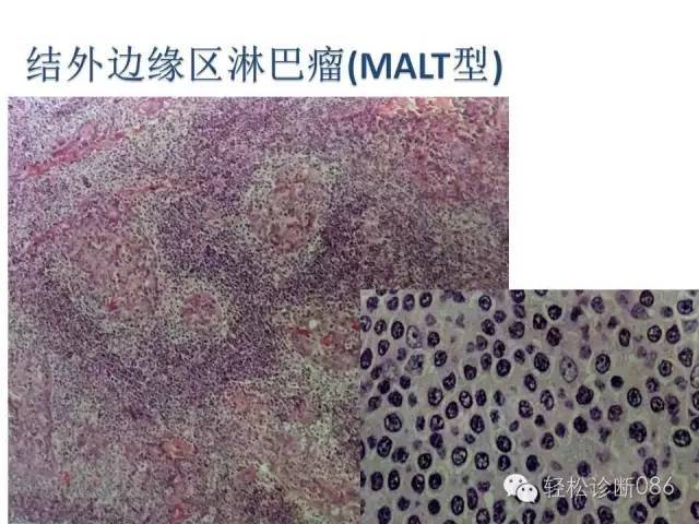 边缘区淋巴瘤（附小B细胞NHL鉴别诊断）