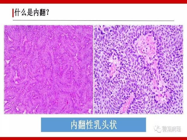 泌尿课程/尿路上皮病变的基本生长方式