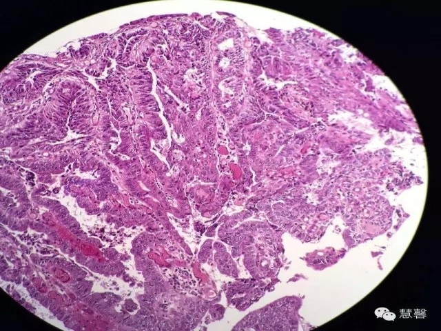 结、直肠管绒毛状腺瘤-高级别病变诊断等相关问题2（悄悄分享、孔祥田(Max)*Roswell*老师讲解）
