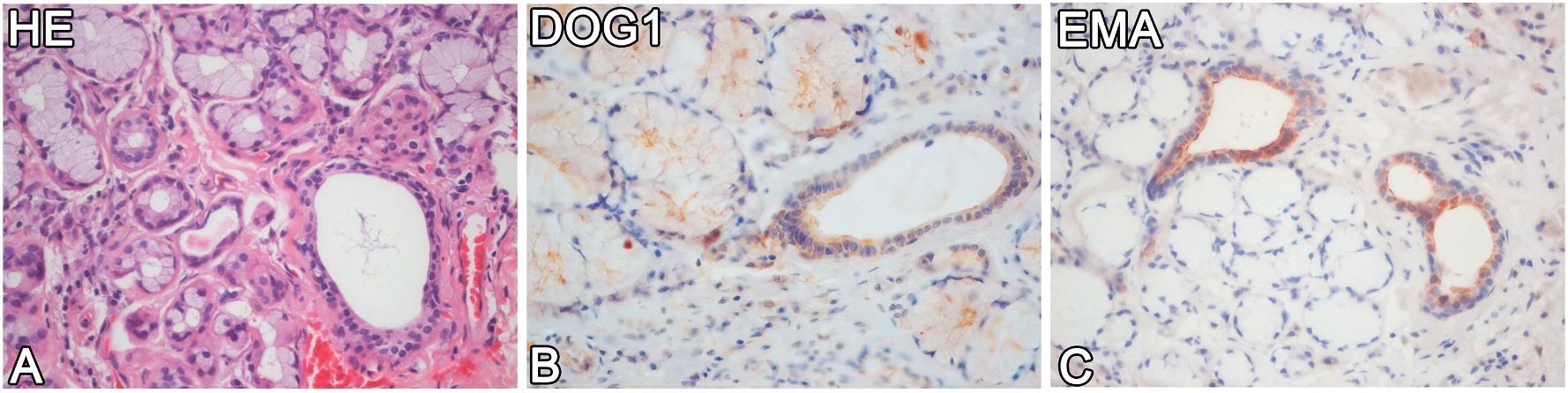 小涎腺肿瘤中EMA、DOG1免疫组化面面观