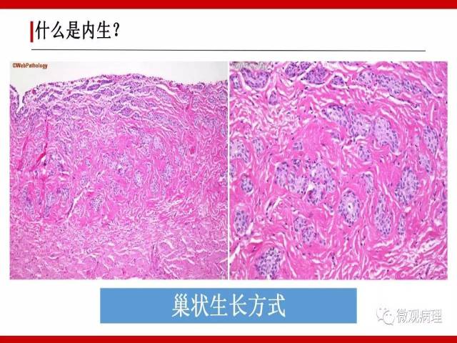 泌尿课程/尿路上皮病变的基本生长方式
