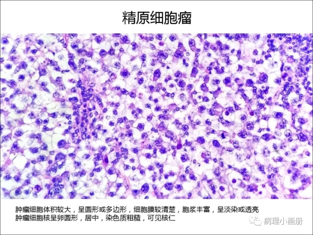 泌尿病理--精原细胞瘤VS精母细胞瘤