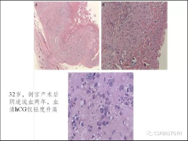 妊娠滋养细胞肿瘤的临床病理学进展