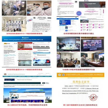 全球首例危重型COVID-19病理活检，发现存在肺纤维化、微血栓形成及血管改变
