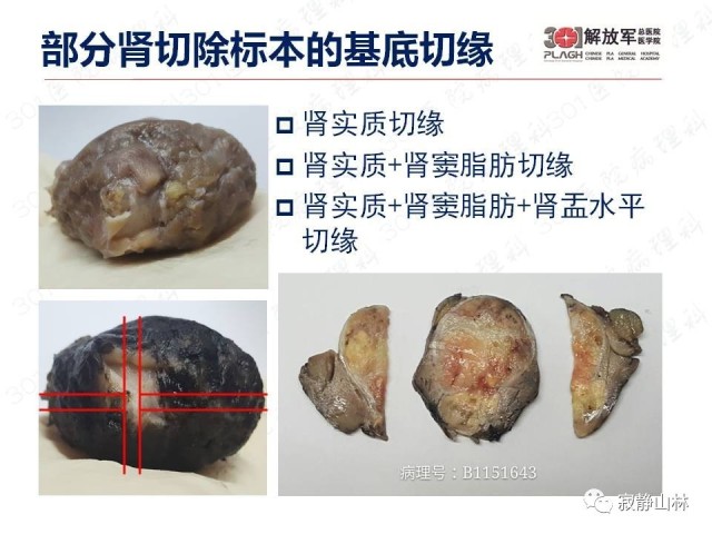 泌尿系统常见肿瘤标本病理报告规范