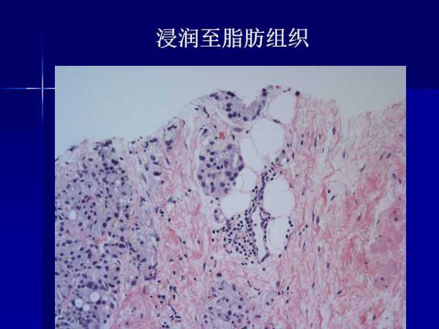 前列腺病理诊断线索（下）——黄教悌