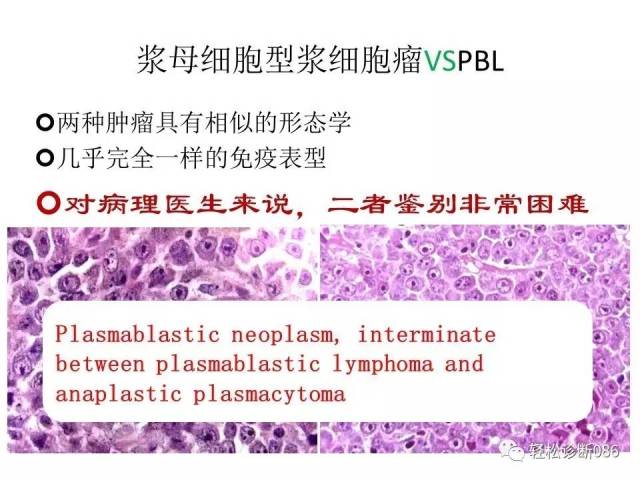浆细胞相关肿瘤的病理诊断及鉴别诊断