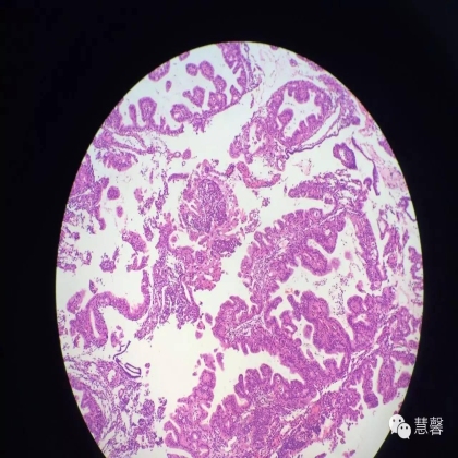 子宫内膜乳头状增生（甜甜分享病例，孔祥田(Max)*Roswell*老师讲解，kent翻译整理文献）