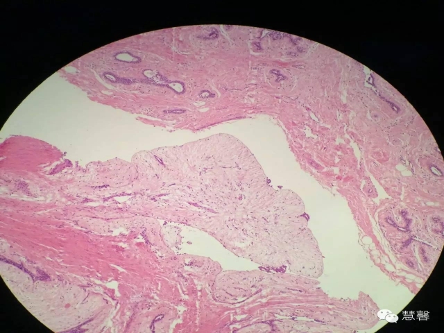 乳腺纤维腺瘤与叶状肿瘤的鉴别要点（李军红分享，孔祥田老师讲解）