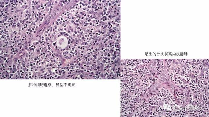 血管免疫母T细胞淋巴瘤