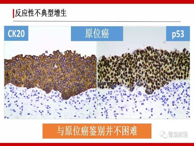泌尿课程/非浸润性尿路上皮病变诊断的一些困惑