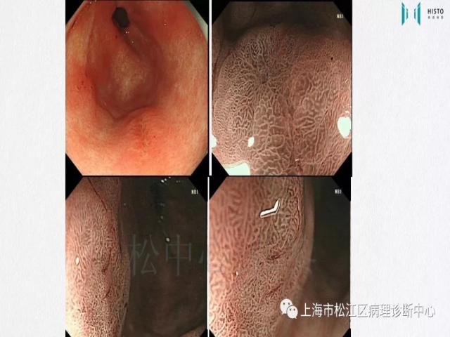 上消化道早癌病理诊断中的困惑及基本对策回顾