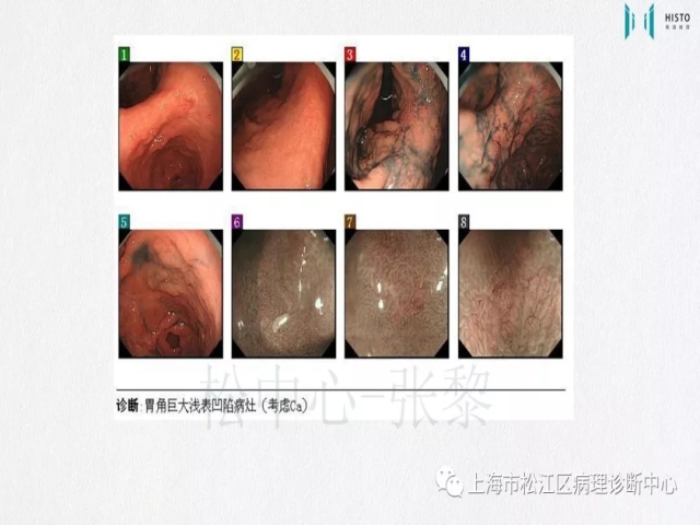 上消化道早癌病理诊断中的困惑及基本对策回顾