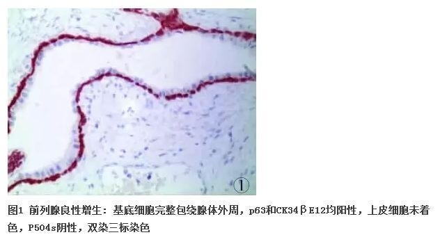 前列腺疾病的免疫组化诊断
