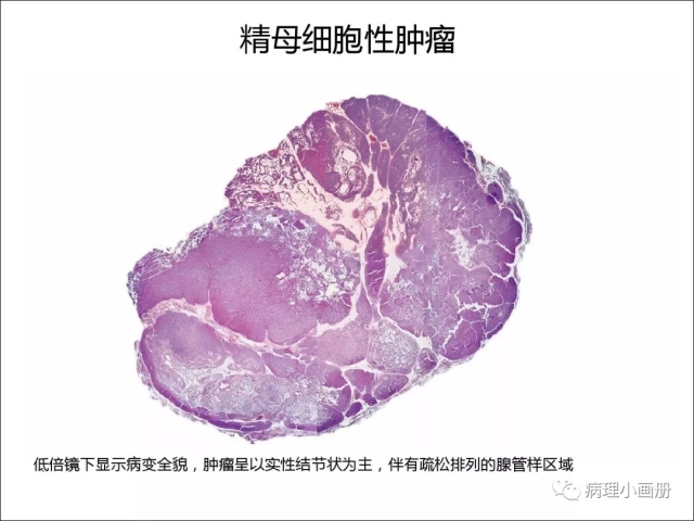 泌尿病理--精原细胞瘤VS精母细胞瘤