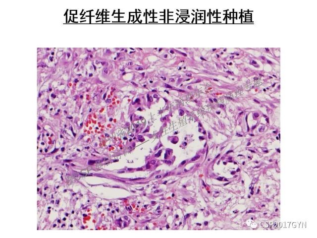 中华病理学会基层培训遵义站讲座（一）——卵巢和输卵管浆液性肿瘤的诊断和鉴别诊断
