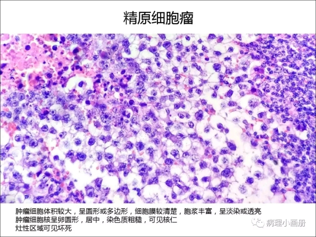 泌尿病理--精原细胞瘤VS精母细胞瘤