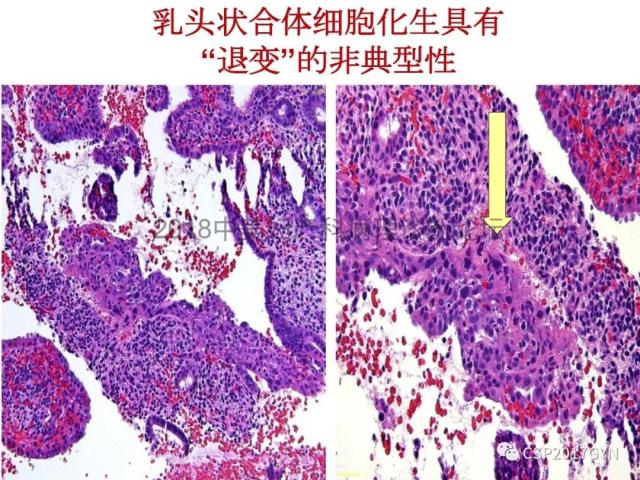 子宫内膜假肿瘤性病变及类似癌样病变