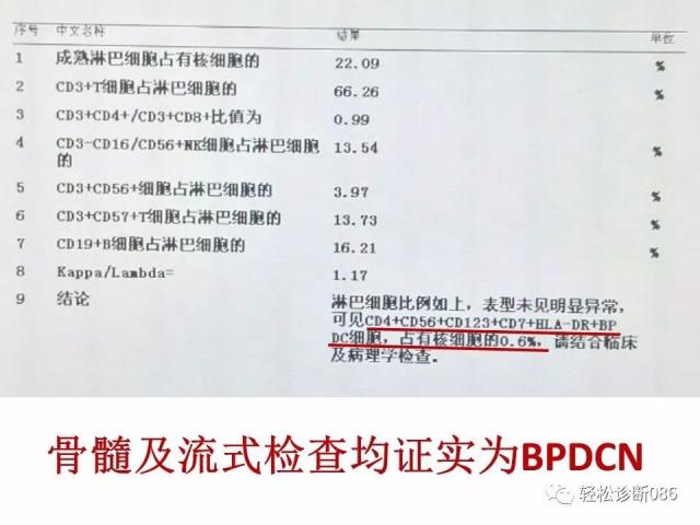 BPDCN病例分享