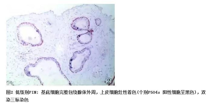 前列腺疾病的免疫组化诊断