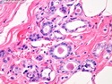 乳腺病理-乳腺良性增生-微腺性腺病