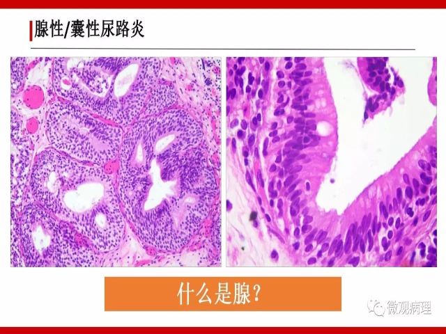 泌尿课程/尿路腺样病变的诊断要点